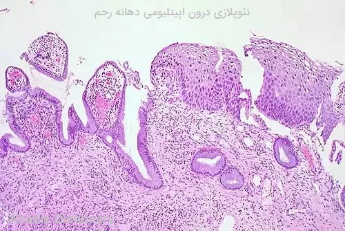 نئوپلازی درون اپیتلیومی دهانه رحم